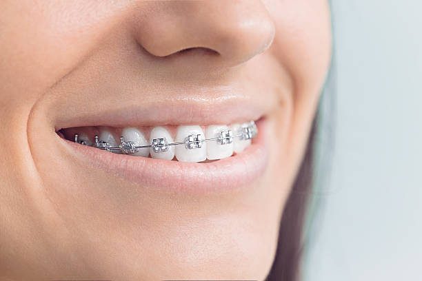 Dental Bonding in Griswold, IA